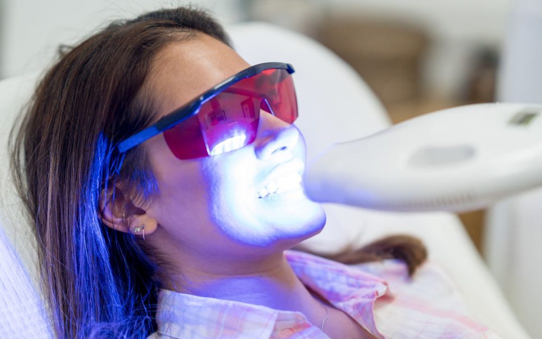 Sbiancamento dentale laser: come funziona, vantaggi e quando farlo